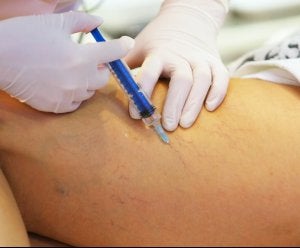 Vein Therapy in Rockville Centre & Long Island