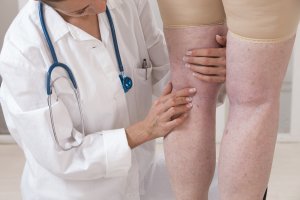 Spider Vein Treatment in Rockville Centre, NY