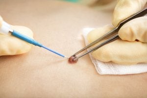 Tumor & Mole Removal treatment in Rockville Centre & Long Island