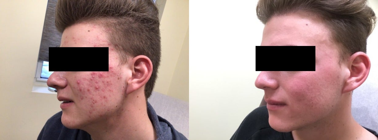 Buy accutane us