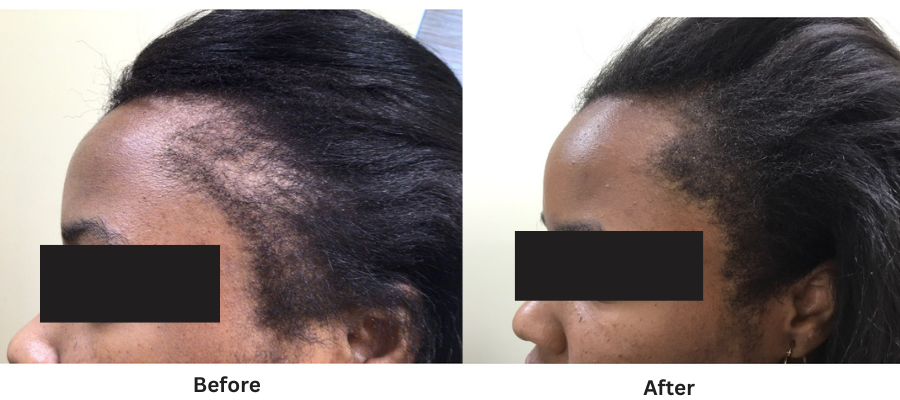 Hair loss treatment in Rockville Centre & Long Island